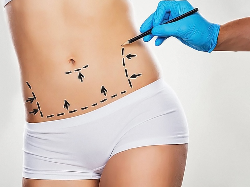 Абдоминопластика