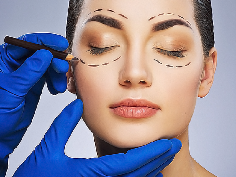 Блефаропластика