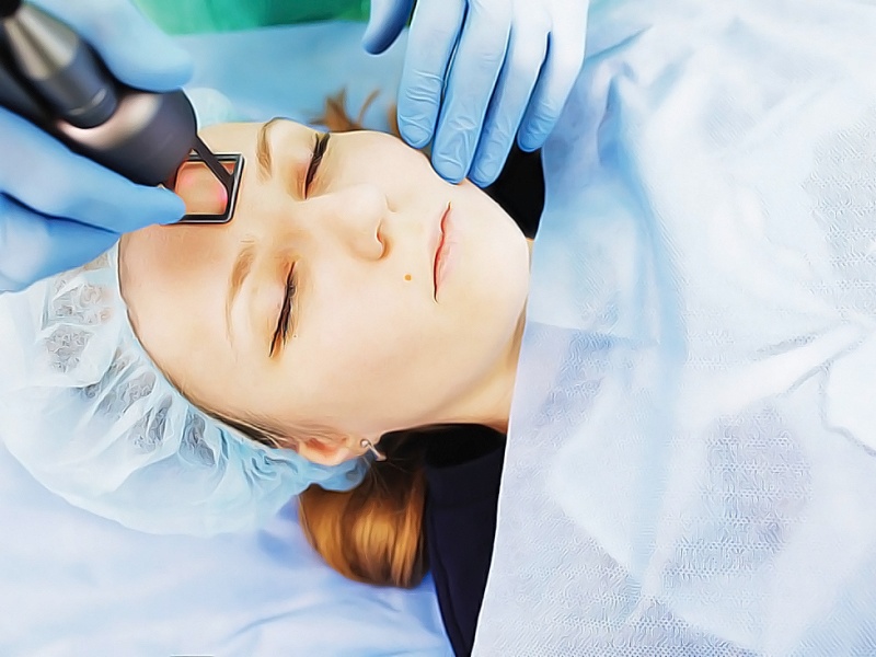 Лазерная шлифовка рубцов