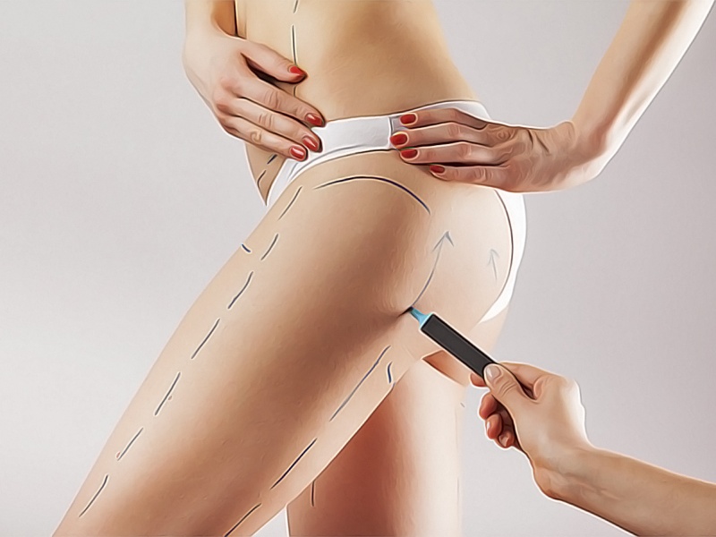 Липосакция бёдер