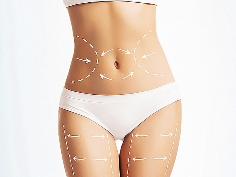 Липосакция