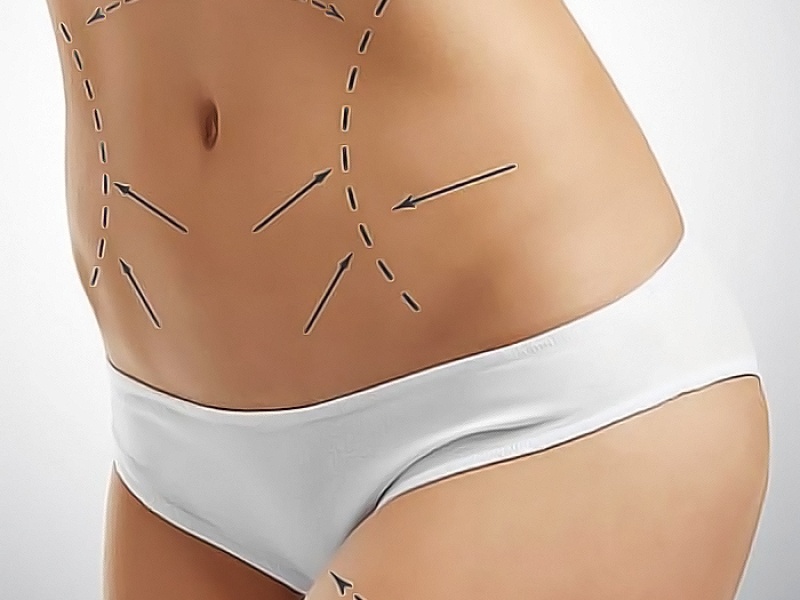 Липосакция живота