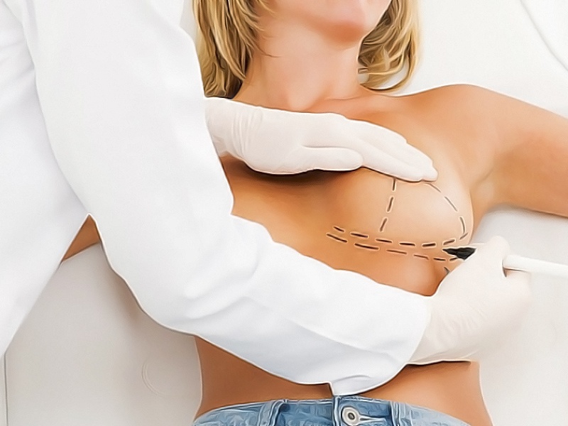 Маммопластика (редукционная и аугментационная)