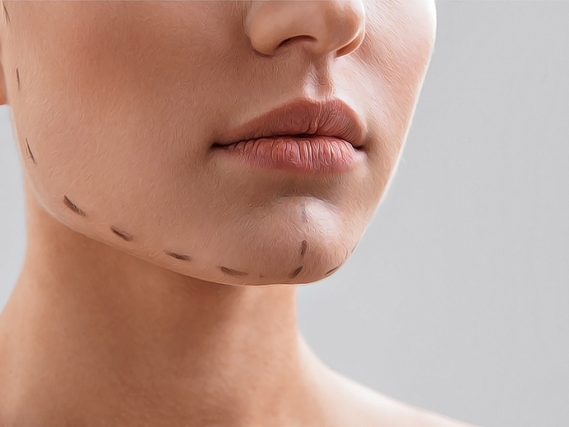 Ментопластика