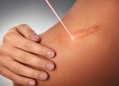 Лазерное удаление нежелательных рубцов и шрамов