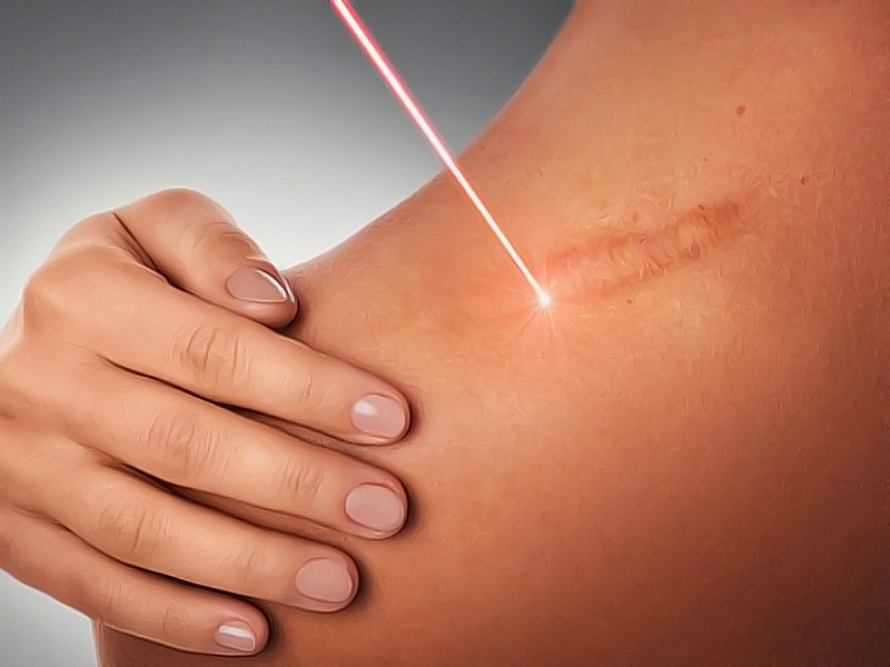 Лазерное удаление нежелательных рубцов и шрамов