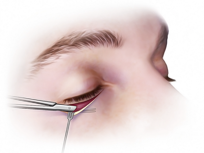 Зачем делать кантопексию и миопексию при стандартной нижней блефаропластике?