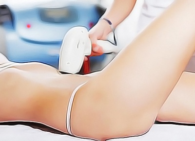 Радиочастотная липосакция