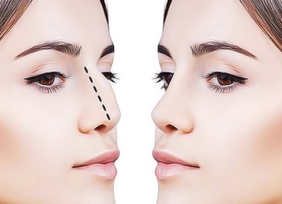 Ринопластика: все, что вы хотели знать