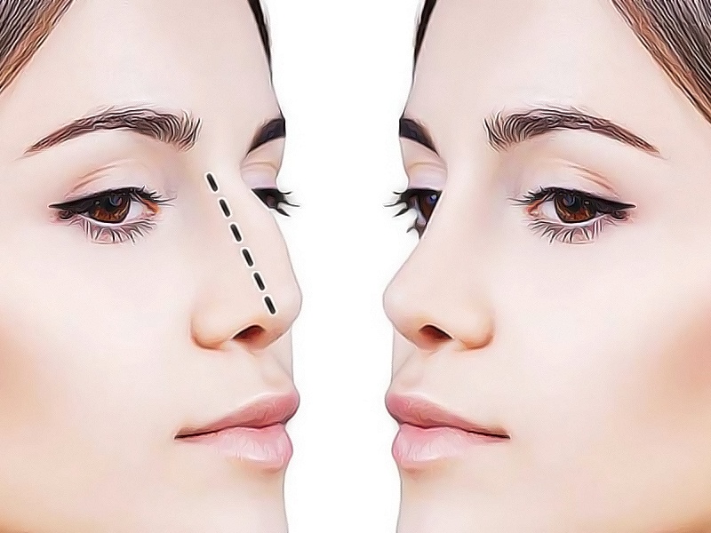 Ринопластика: все, что вы хотели знать