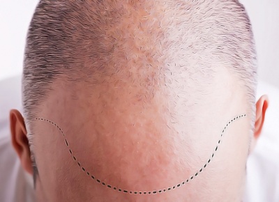 Трансплантация волос