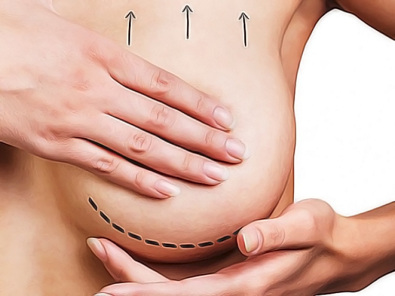 Мастопексия периареолярная