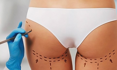 Липофилинг растяжек