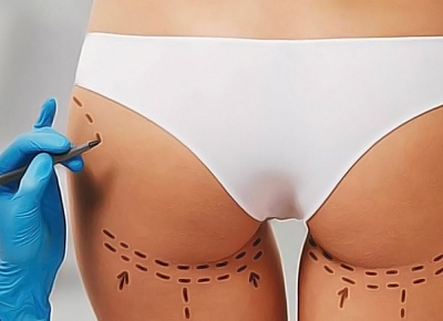 Липофилинг растяжек