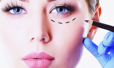 Нижняя блефаропластика