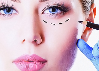 Нижняя блефаропластика