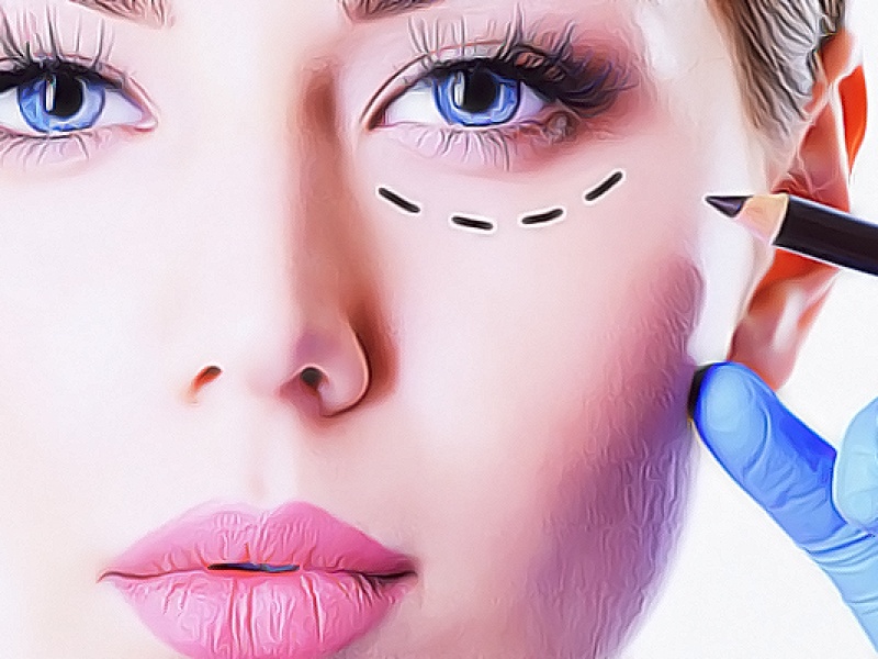 Нижняя блефаропластика