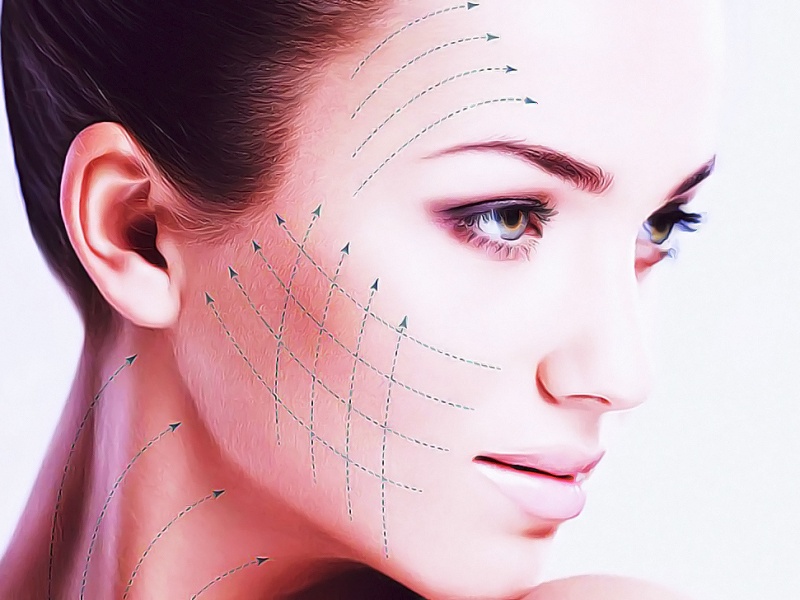 Нитевое армирование Visage Aptos