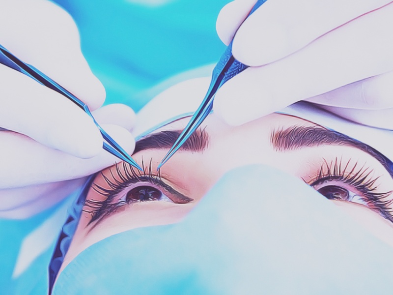 Верхняя блефаропластика