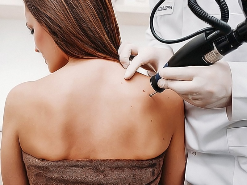 Безрубцовое удаление родинок