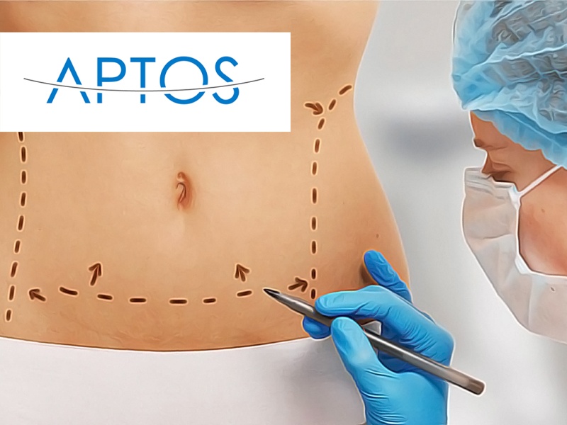 Подтяжка живота нитями Aptos