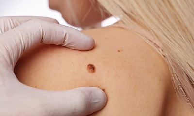 Все о родинках: какие можно удалять, а какие нельзя?