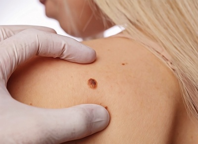 Все о родинках: какие можно удалять, а какие нельзя?