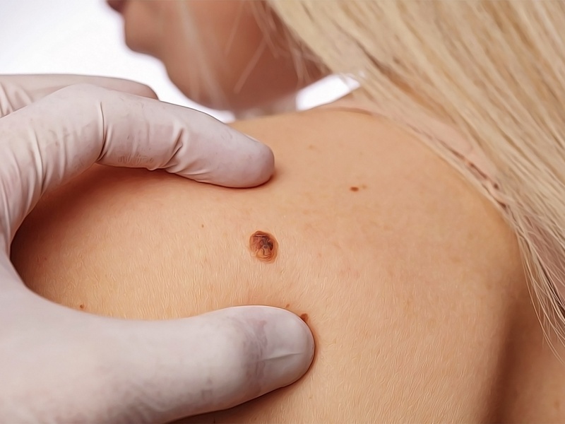 Все о родинках: какие можно удалять, а какие нельзя?