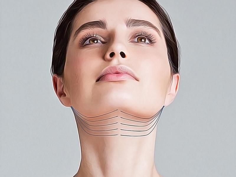 Подтяжка шеи. Как убрать следы возраста