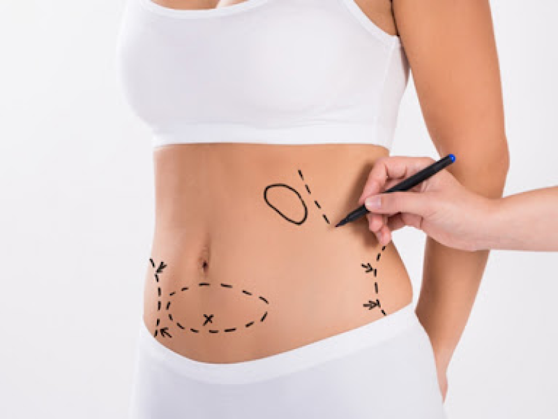 Опасна ли липосакция?