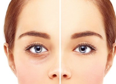 Блефаропластика: за и против