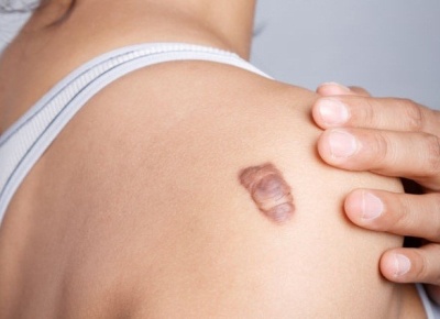Рубцы после операции: что делать и как убрать. Виды рубцов после операции