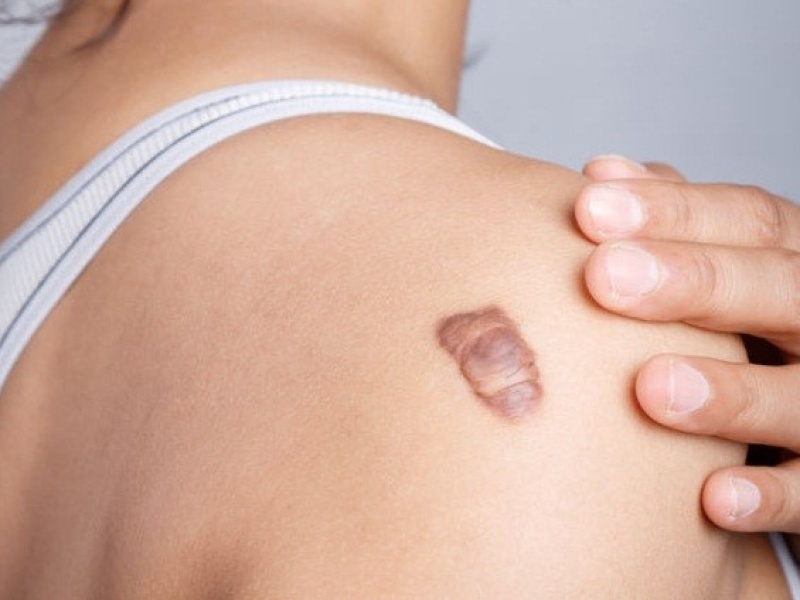 Рубцы после операции: что делать и как убрать. Виды рубцов после операции