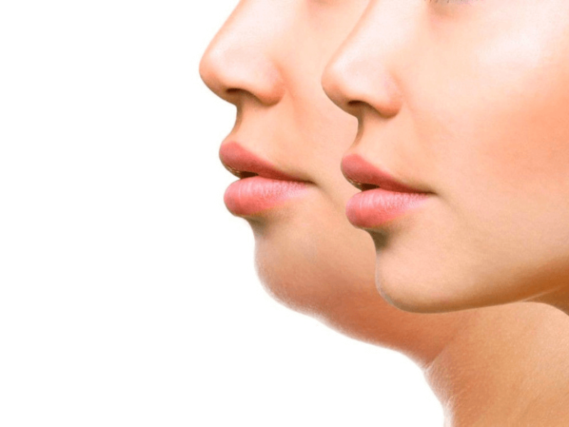 Жировые ловушки на лице