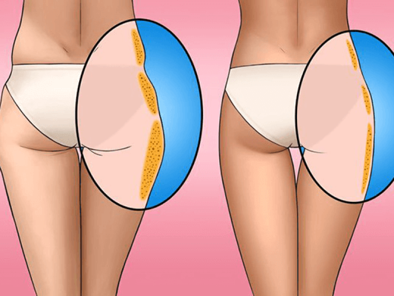 Жировые ловушки на бедрах