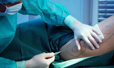 Реабилитация после липосакции