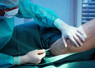 Реабилитация после липосакции