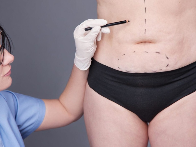 Какие проблемы решает липосакция
