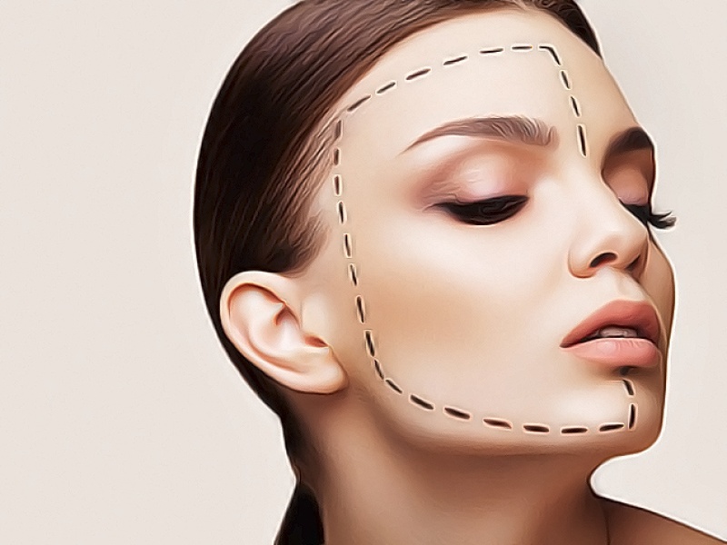 СМАС лифтинг (SMAS)