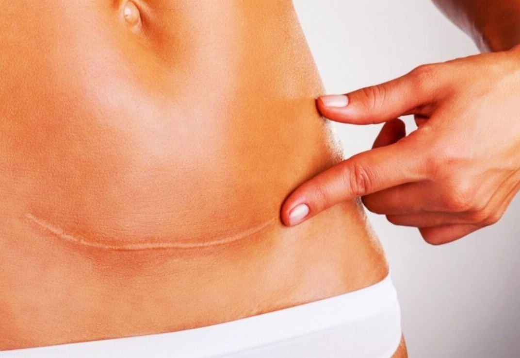 Рубцы после операции