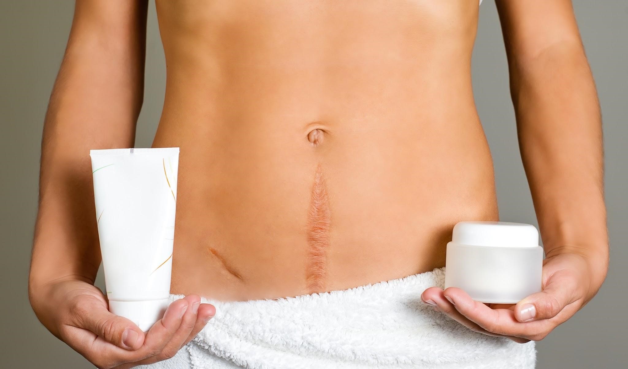 Коррекция рубца после операции