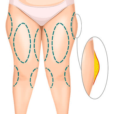 Избавиться от жировых ловушек на бедрах